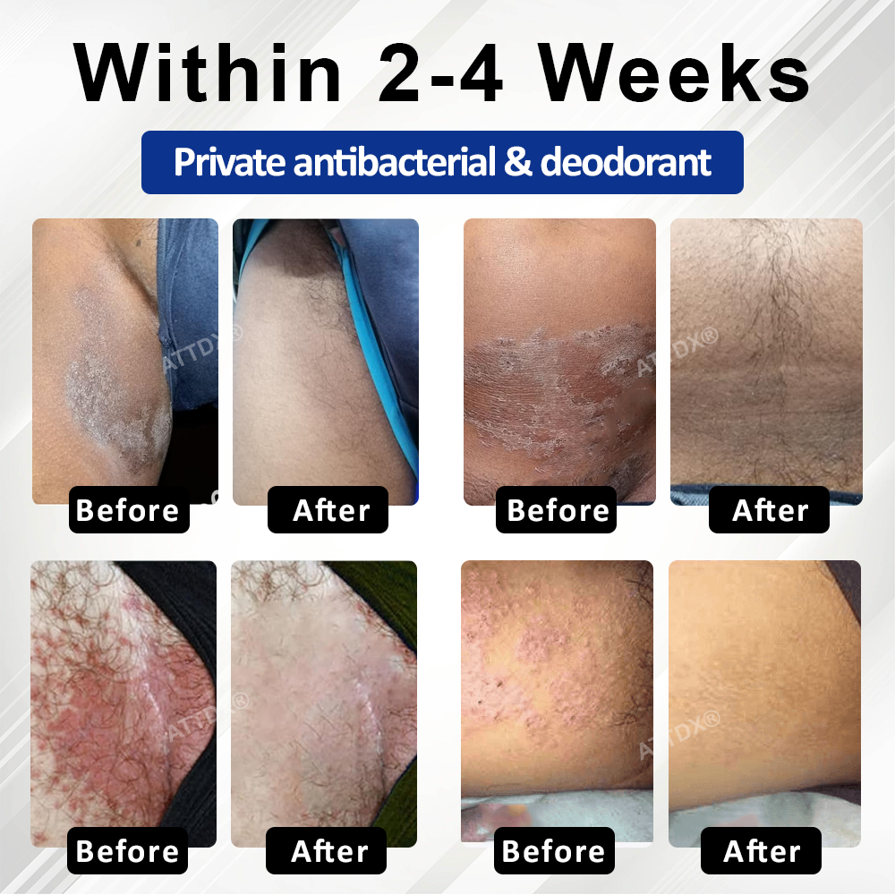 LicorRelief Man Genital Antifungal Cream