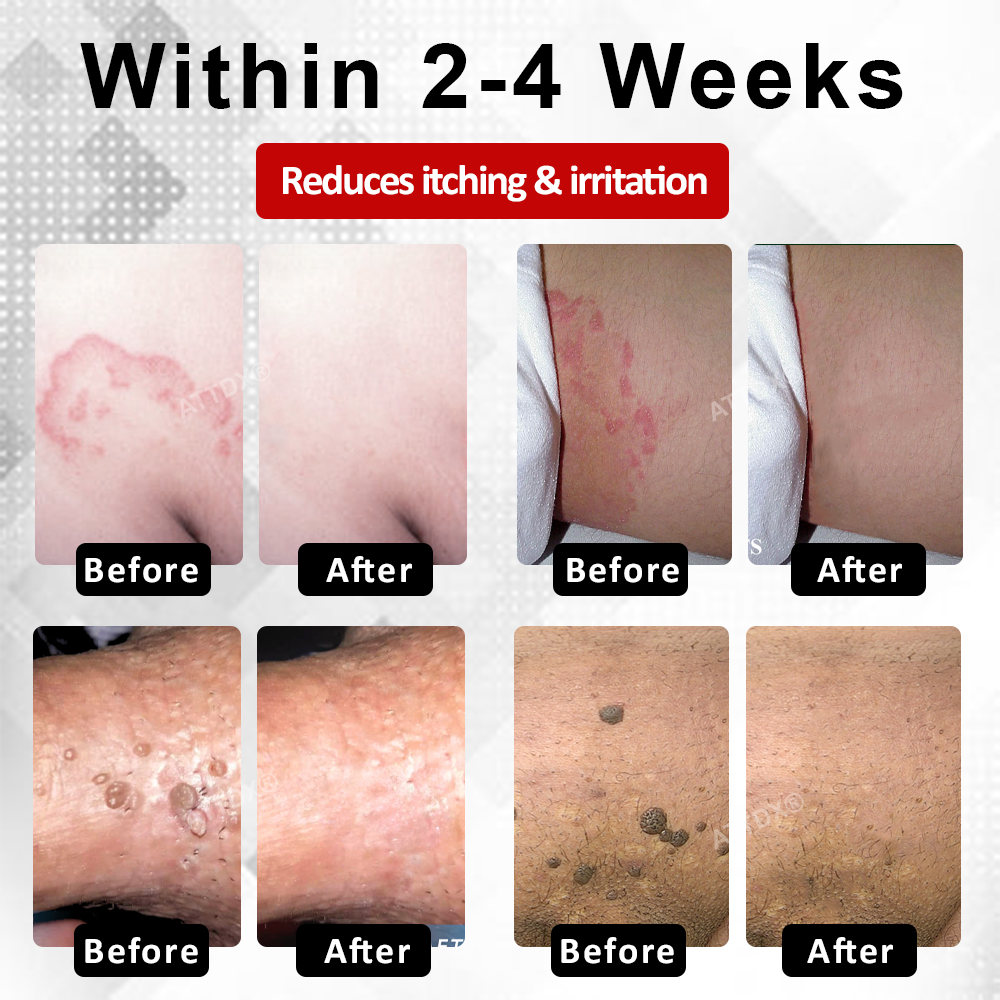 Men's HPV Warts Care Spray