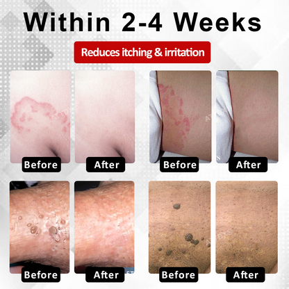 Men's HPV Warts Care Spray