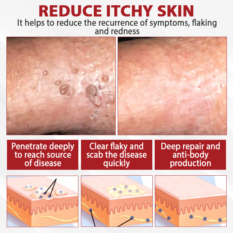 Men's HPV Warts Care Spray