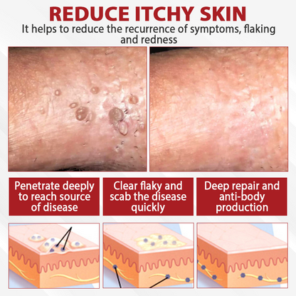 Men's HPV Warts Care Spray