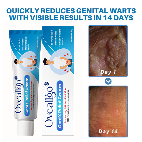HPV Genital Warts Relief Cream